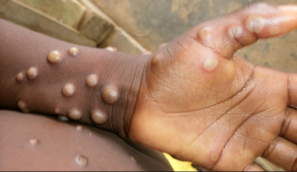 Monkeypox: Virologist urges government to acquire smallpox vaccines
