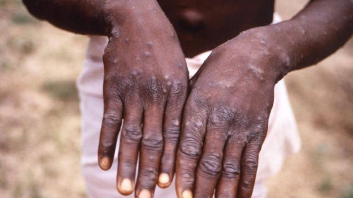 NCDC alerts Nigerians about increasing cases of monkey pox