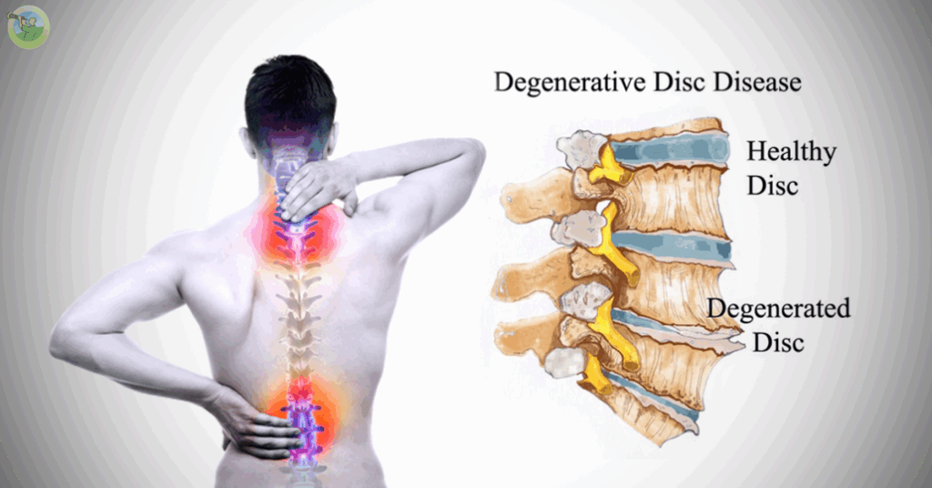 Degenerative Disc Disease