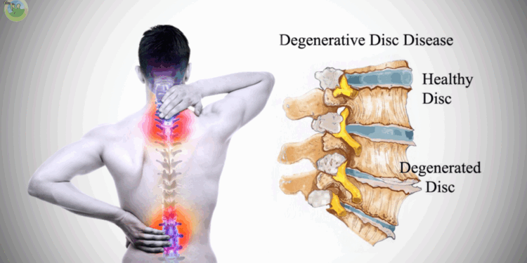 Degenerative Disc Disease