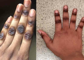 How to get Rid of Dark Knuckles