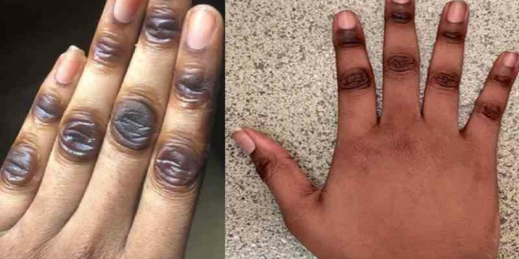 How to get Rid of Dark Knuckles