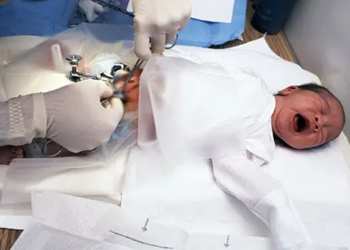 Methods to Circumcise a Baby