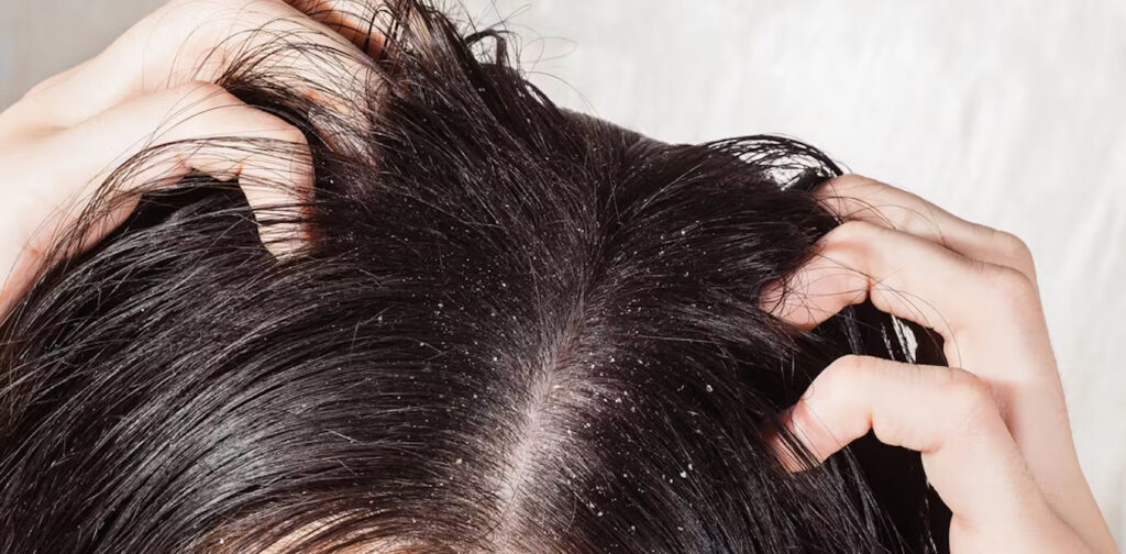 How to Get Rid of Dandruff Naturally