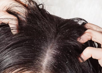 How to Get Rid of Dandruff Naturally