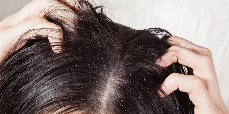 How to Get Rid of Dandruff Naturally