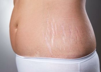 How to Remove Stretch Marks