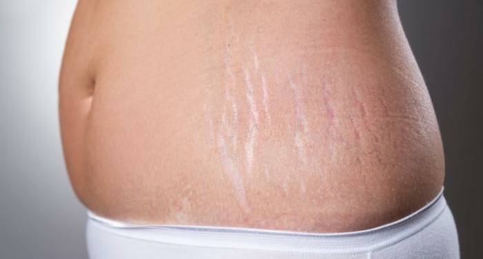 How to Remove Stretch Marks