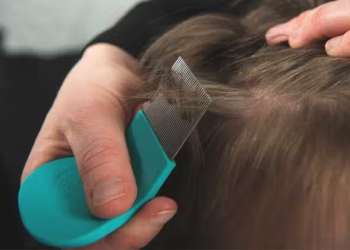 How to Get Rid of Lice Naturally