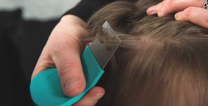 How to Get Rid of Lice Naturally