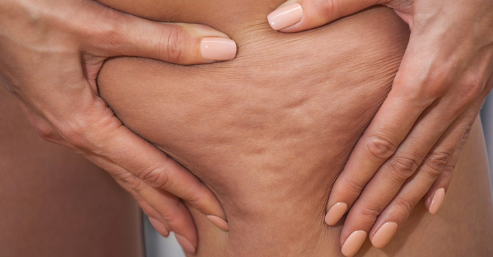 How to Get Rid of Cellulite