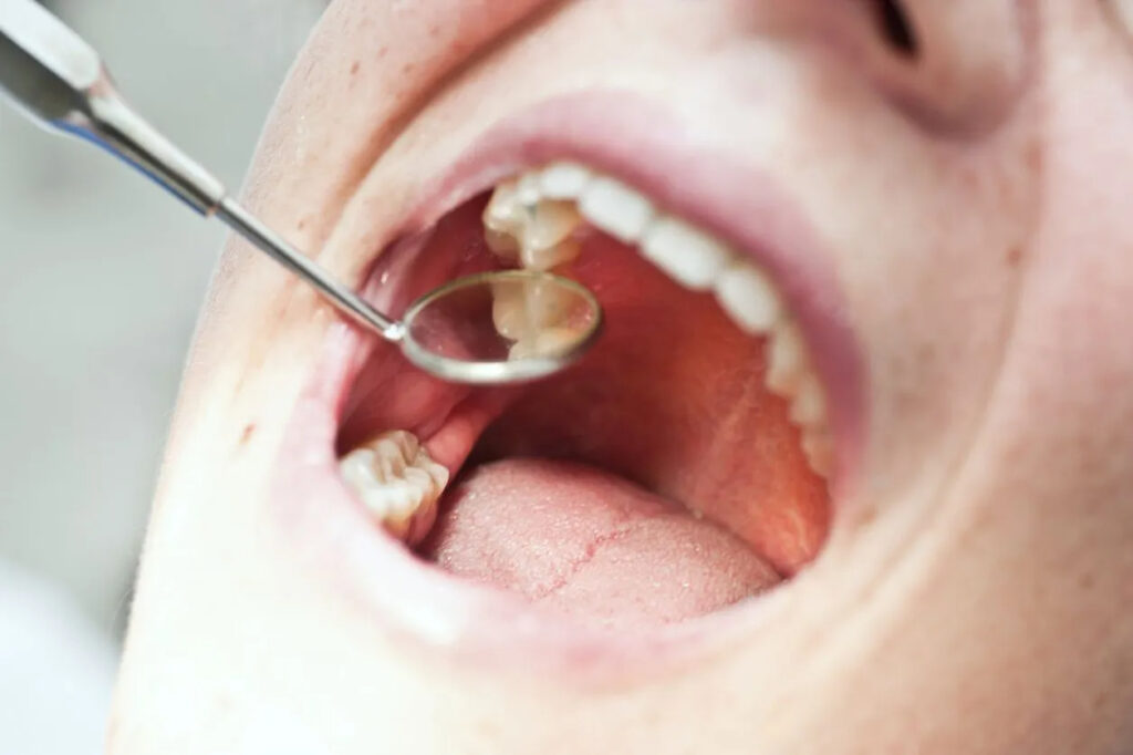 Causes of Tooth Pain