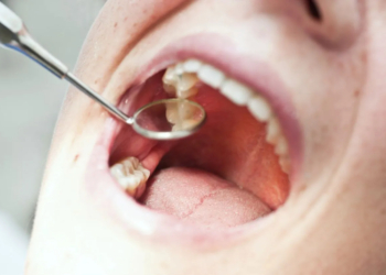 Causes of Tooth Pain