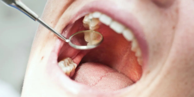 Causes of Tooth Pain