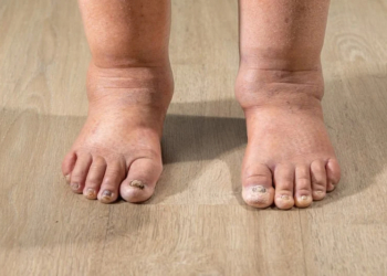 How to Get Rid of Swollen Ankles Fast