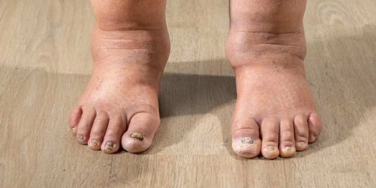 How to Get Rid of Swollen Ankles Fast