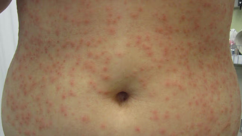 How to Get Rid of a Rash