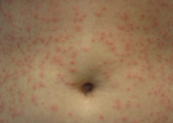 How to Get Rid of a Rash