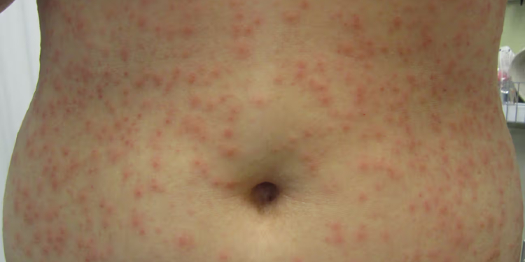 How to Get Rid of a Rash