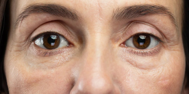 How to Get Rid of Bags Under the Eyes