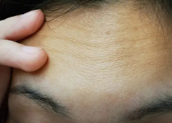 How to Get Rid of Forehead Wrinkles Without Botox