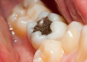 Dangers of Amalgam Fillings