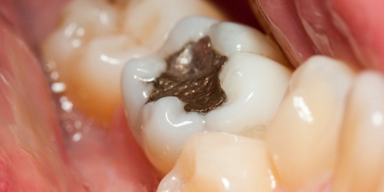 Dangers of Amalgam Fillings