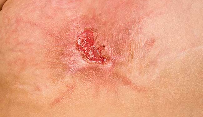 Staphylococcus Aureus Infection