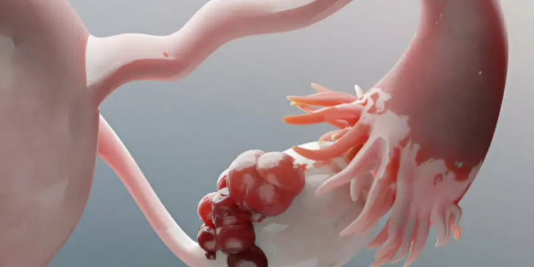 What Size of Ovarian Cyst is Dangerous?