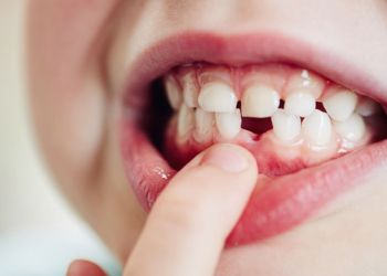 When Do Kids Start Losing Teeth