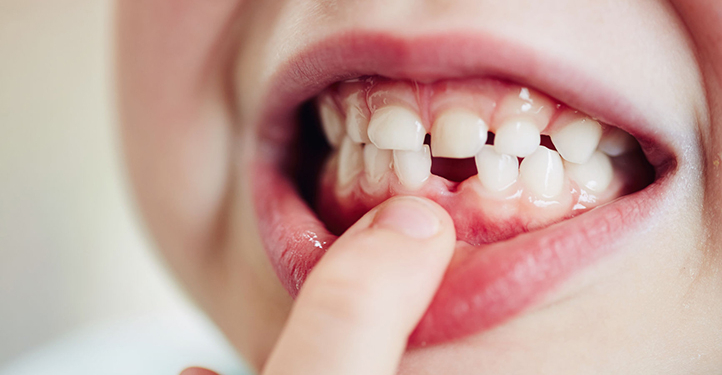 When Do Kids Start Losing Teeth