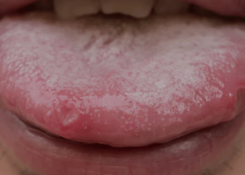 Why Does the Tip of My Tongue Hurt?