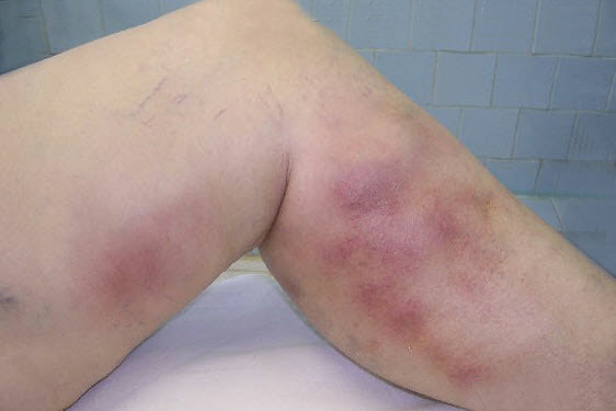 Phlebitis