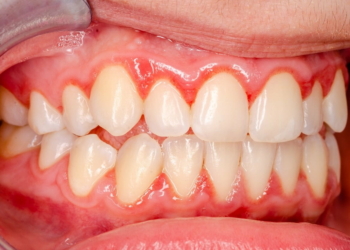 What is Gingivitis and How Do You Treat It?