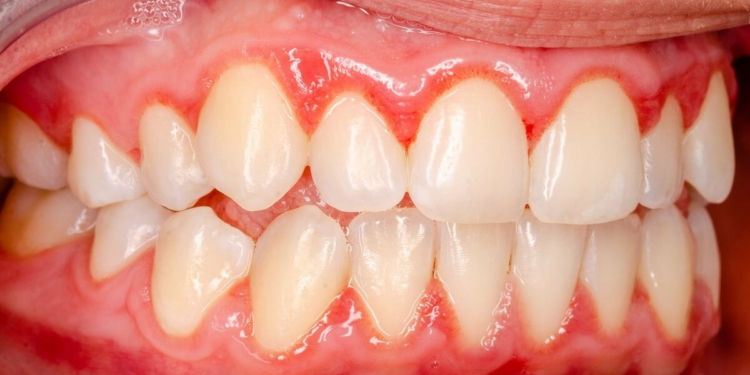What is Gingivitis and How Do You Treat It?