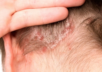 How to Treat Scalp Psoriasis