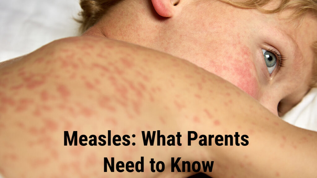 Measles: