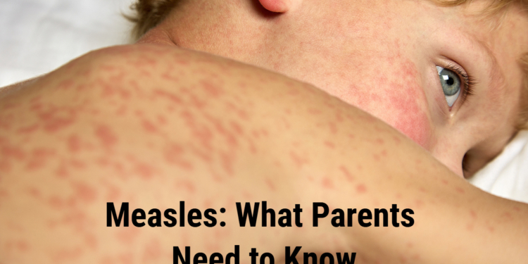 Measles: