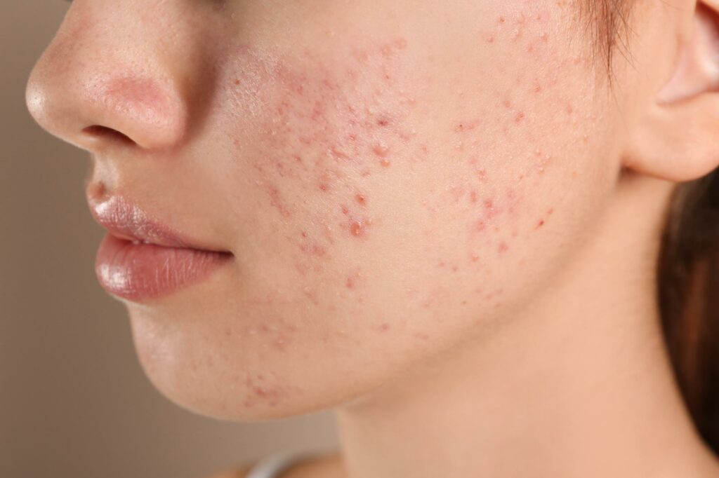 How to Treat Acne Naturally