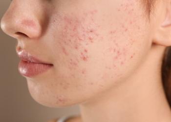 How to Treat Acne Naturally