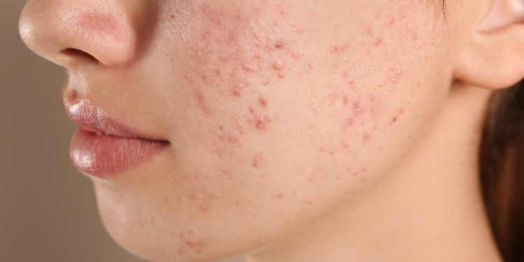 How to Treat Acne Naturally