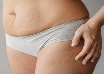 How to Remove Stretch Marks: 7 Effective Natural Remedies