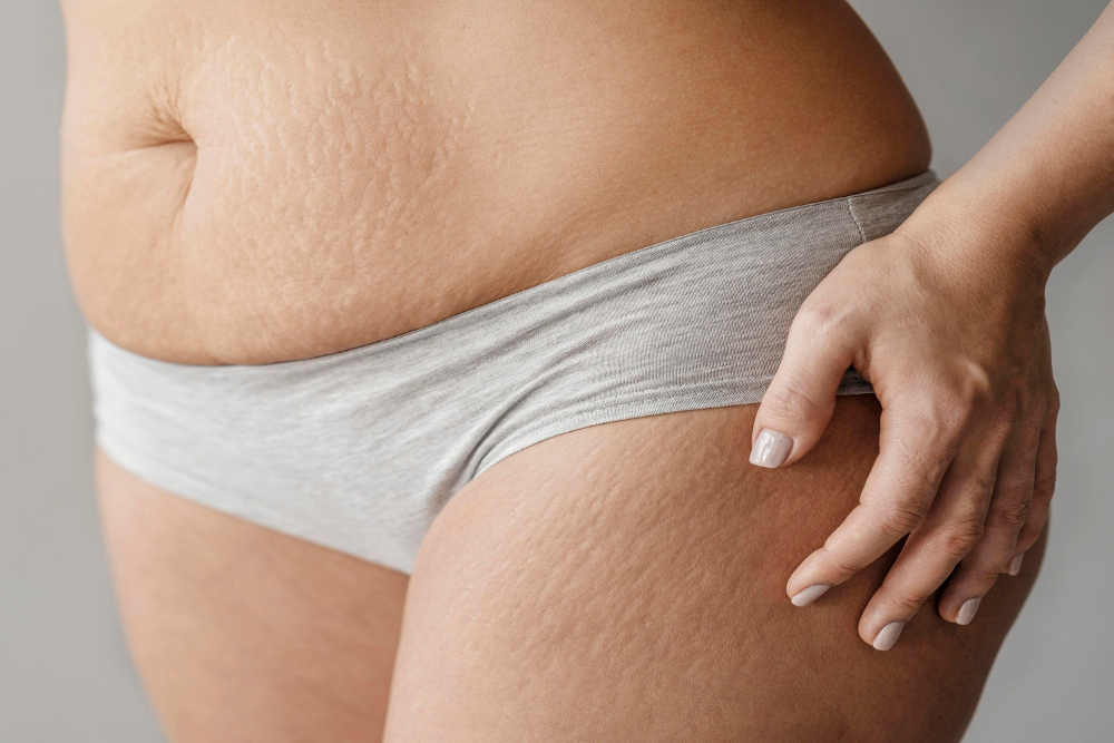 How to Remove Stretch Marks: 7 Effective Natural Remedies