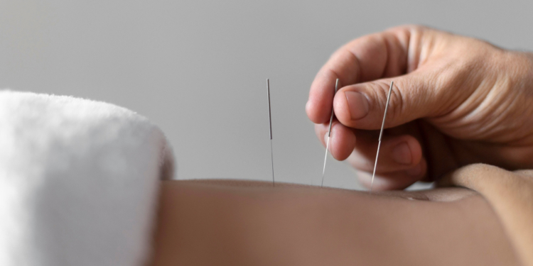 Steps to become an acupuncturist