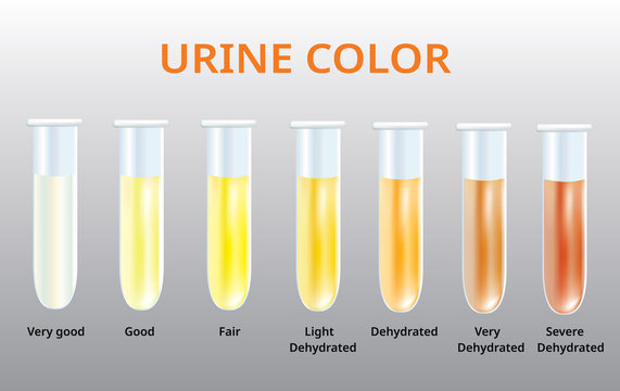 WHAT YOU SHOULD KNOW ABOUT YOUR URINE COLOR