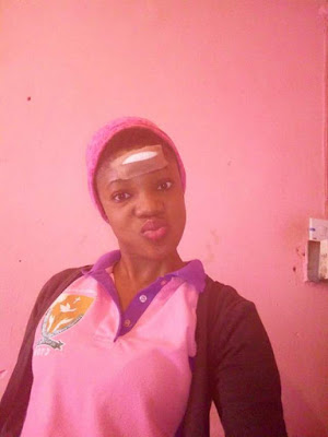  Photos: "I had to pass through the terror of having my face stitched" - Lady narrates how she was hit and dragged along the road by Okada rider