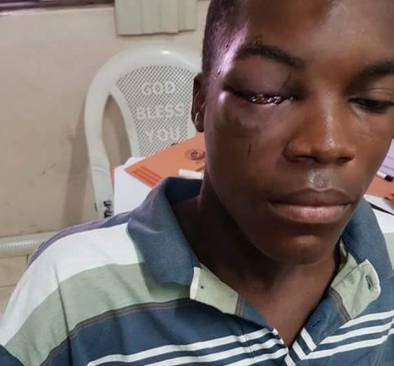  Photos: Student of Ojodu Grammar School stabbed in the eye by fellow student