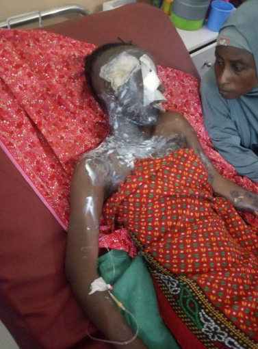 Graphic! UNIMAID female student battling for her life after she was kidnapped, robbed, raped and doused with acid 
