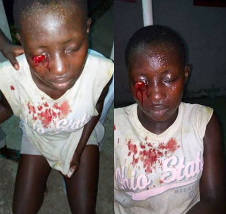 Graphic Photo: Secondary school?student stabs classmate in the eye for refusing to join cult