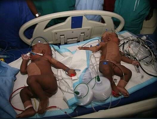 Photos: Federal Medical Center,?Yola successfully separates conjoined female twins